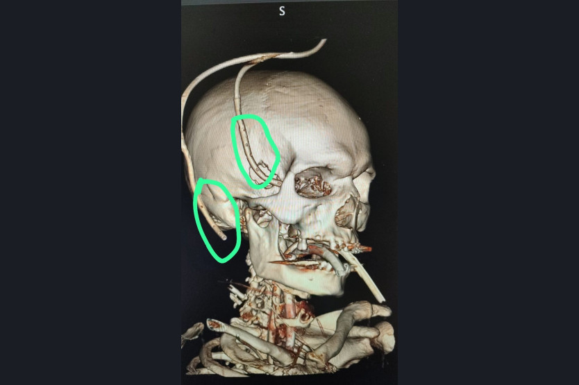В Новосибирске спасли мужчину с вилами в голове 